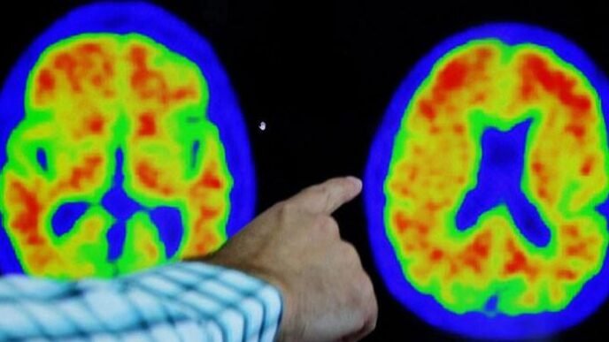 Are new Alzheimer's drugs the revolution doctors have been waiting for?