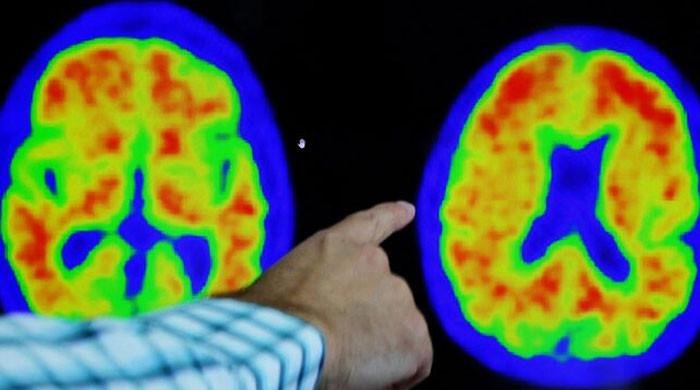 Are new Alzheimer's drugs the revolution doctors have been waiting for?