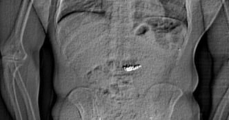 Thief who swallowed $770K worth of Tiffany earrings 'expelled' them over 12 days later, Florida police say