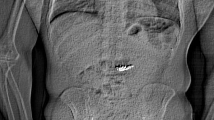 Thief who swallowed $770K worth of Tiffany earrings 'expelled' them over 12 days later, Florida police say